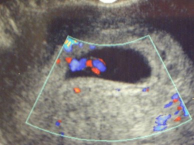 Boswell-1 8w umb cyst