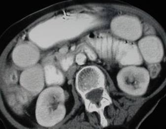 SBO w femoral hernia-1