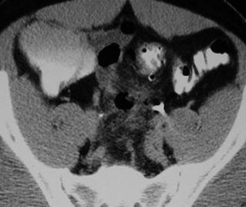 Sigmoid Diverticulitis-5