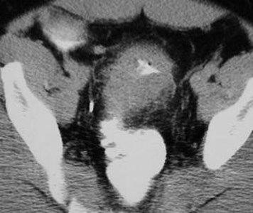 Sigmoid Diverticulitis-7