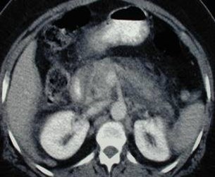 Pancreatitis-1