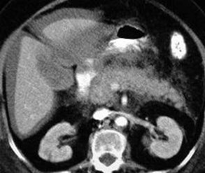 Hemorrhagic Pancreatitis-2