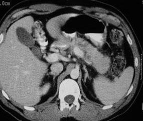 Pancreatitis w PSA-2