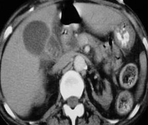 Ruptured GB w dilated ducts-2