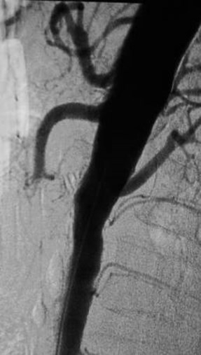 SMA thrombus-Afib-6