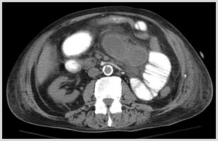 C:\Users\Ryan\Desktop\Desktop Data\Radiology\TEACHING FILES\Bowel\Closed loop obstruction, surgically proven\closed loop obstruction, surgically proven.01.jpg