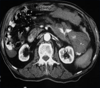 Splenic injury w acute hemorrhage-2