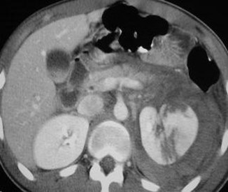 Renal laceration w collecting system extravasation-1