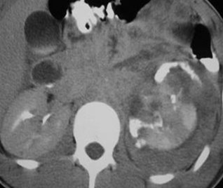 Renal laceration w collecting system extravasation-5