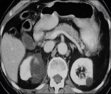 Renal cyst w hemorrhage-1