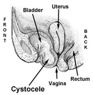 Cystocele