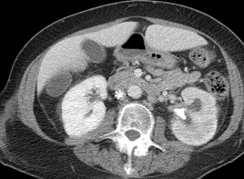 delayed L nephrogram.jpg