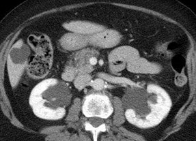 nephrograhic phase