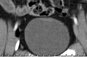 routine CT, cor bladder wall thickening.jpg