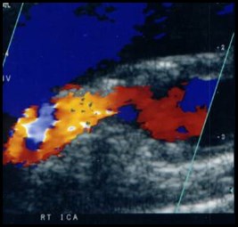 RICA stenosis color-2