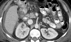 Renal Abscess 1