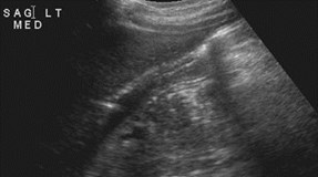 Sinclair, Shemeka, pancreatitis simul L renal mass-US-2