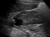 US R cyst w calcif 2