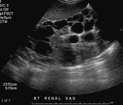 ADPCKD, 49yo w hematuria-1.jpg