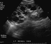 ADPCKD, 49yo w hematuria-2.jpg