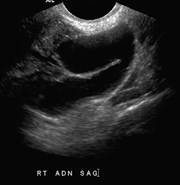 sag RT, hydrosalpinx.jpg
