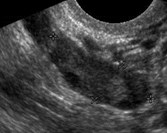 normal right ovary