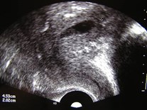 TRUS uterus sag-1