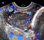 hem Rt corp luteal cyst