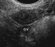 echogenic foci