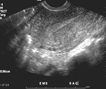 5-26 post ov endometrium.jpg