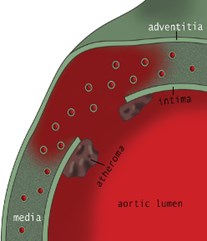 castaner figure ulcer 3