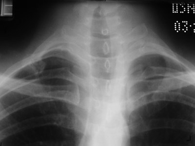 pseudoarthrosis 1st rib 2 