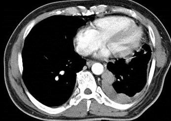 Gasper P malignant thymoma-1