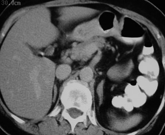 Wilson-  pyelo in pancake kidney-adrenal level-CT1