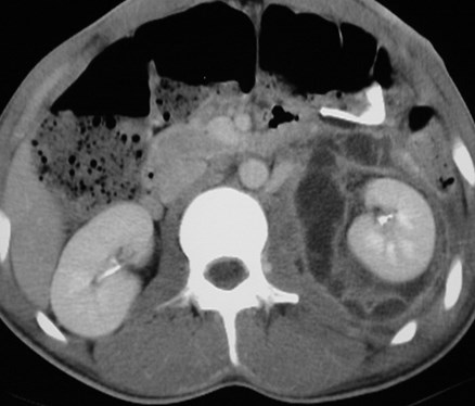 Pancreatic trauma with perinephric pseudocyst-CT