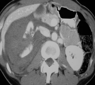 Grose-FX kidney initial-CT1