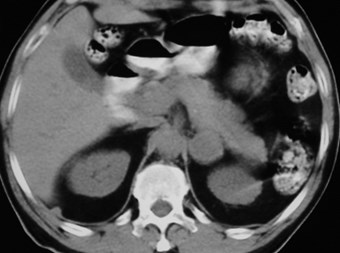 Hutchinson-lung CA mets-left adrenal