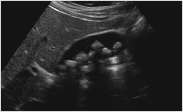 H:\RSmith\Teaching Files\Gallbladder\Cholelithiasis - seen on US but not on CT\Sag GB US.tif