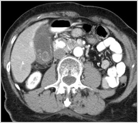 C:\Users\Ryan\Desktop\Desktop Data\Radiology\Multiple Case Conference\Acute Non GI Cases\2. Acute calculous cholecystitis - ct\acute calculous cholecystitis on ct.03.jpg