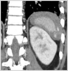 H:\RSmith\Teaching Files\Spleen\Lac and active extravasation\lac and bleed coronal.tif