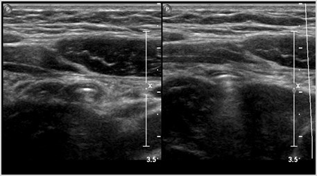 H:\RSmith\Teaching Files\Appendix\Normal Appendix Ultrasound\transverse.tif