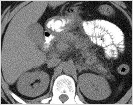 C:\Users\Ryan\Desktop\Desktop Data\Radiology\TEACHING FILES\Pancreas\Pancreatitis\CT axial 1.jpg