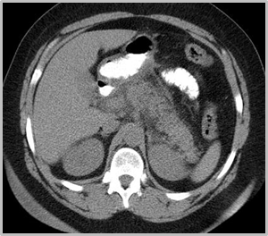 C:\Users\Ryan\Desktop\Desktop Data\Radiology\TEACHING FILES\Pancreas\Pancreatitis\CT axial 3.jpg