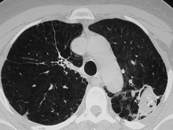 G:\photos\infection\fungal diseases\mycetoma Rembert\hrct 2.JPG