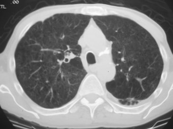 G:\photos\infection\Tuberculosis\TB cavity with scar\ct4.JPG