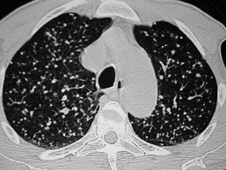 G:\photos\infection\Tuberculosis\miliary champion 82 yo\ct1.JPG