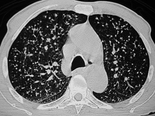 G:\photos\infection\Tuberculosis\miliary champion 82 yo\ct2.JPG