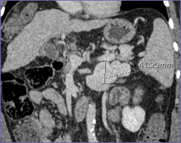 pre op CT 2.jpg