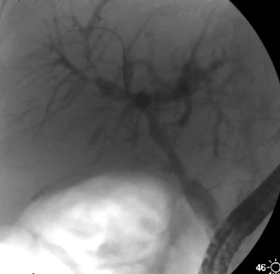 ERCP post dilat.jpg