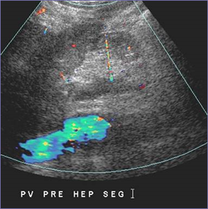 pre-hep PV thrombosed
